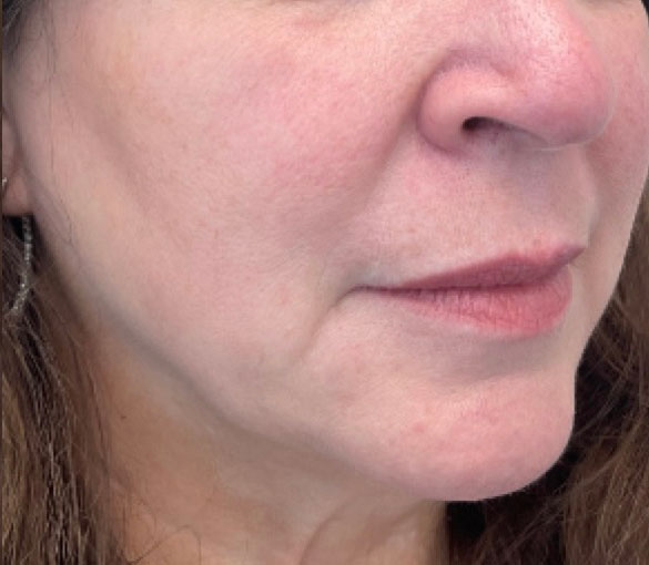 After treatment result 03
