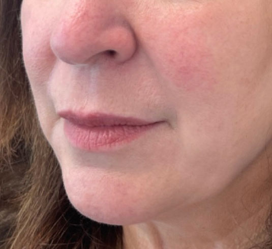 After treatment result 04
