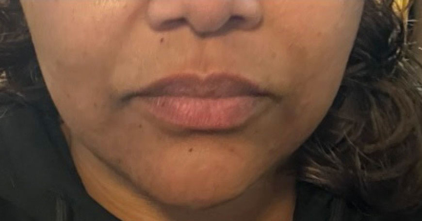 After treatment result 05