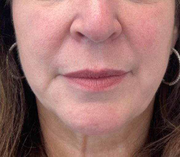 After treatment result 06