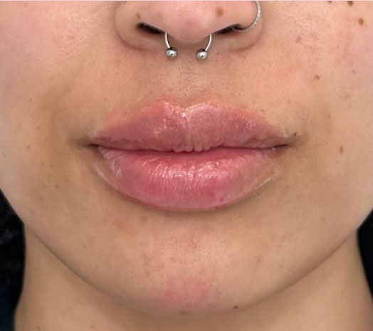 After treatment result 07