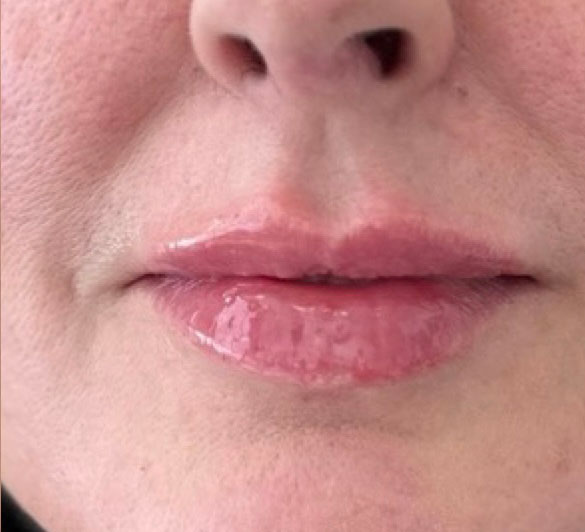 After treatment result 09