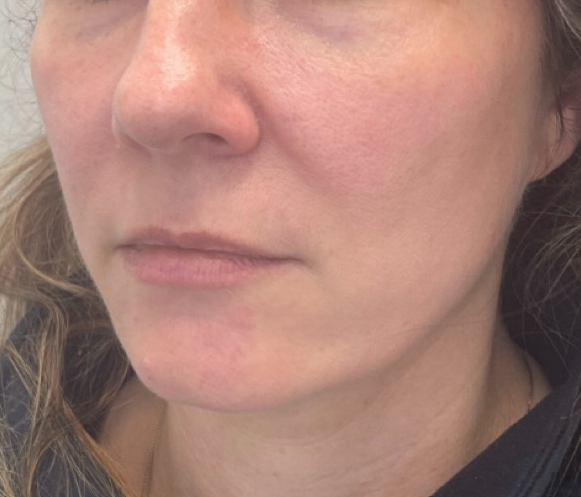 Before treatment result 01
