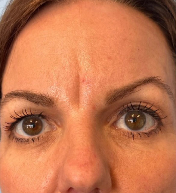 Before treatment result 02