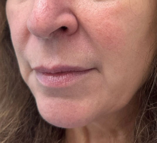 Before treatment result 04